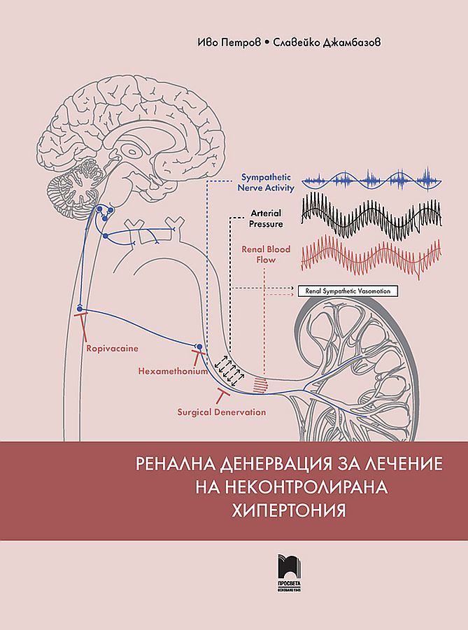Ренална денервация за лечение на неконтролирана хипертония